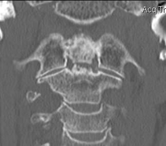 Type 2 Dens Nonunion Coronal CT